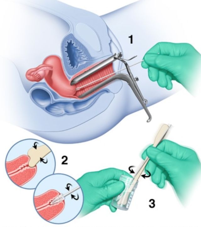 【孕期检查】Pap Test/Smear是啥？医生说一串英语听不懂啊？