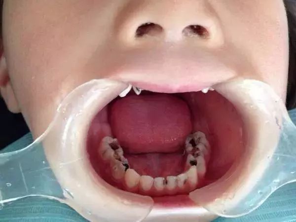 吓人1岁宝宝牙被蛀光2岁女童一口色素牙5岁男童上切牙烂到牙龈新牙都